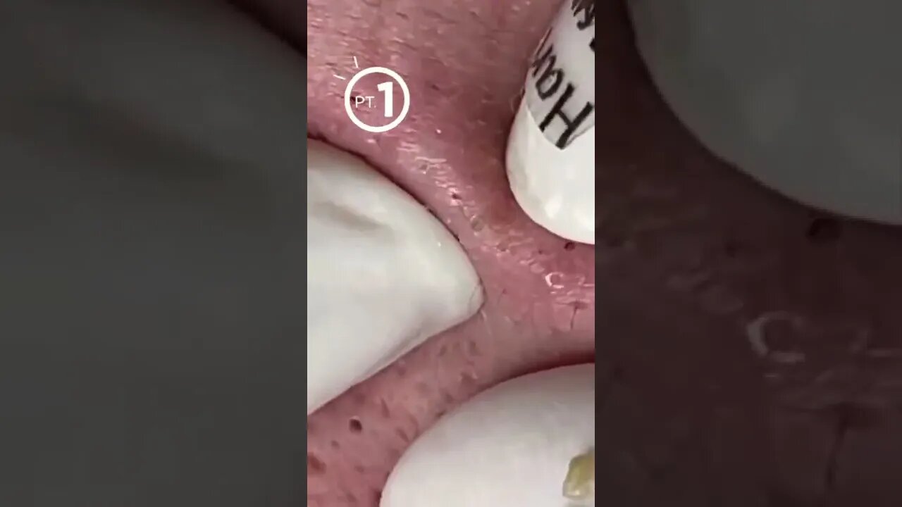 Big Blackheads on the face !