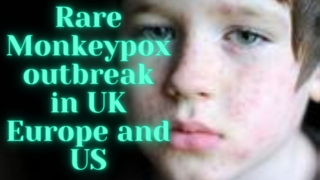 Rare monkeypox outbreak in UK, Europe, and US