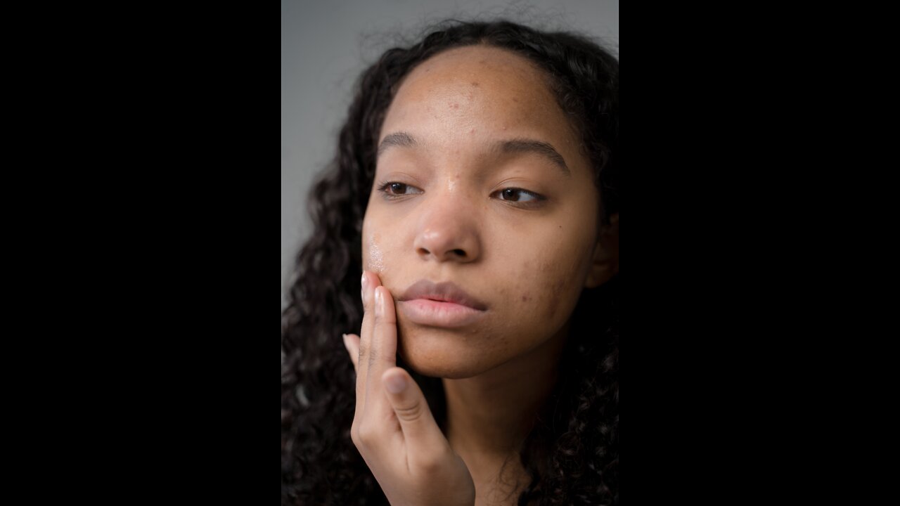 DIFFERENCE BETWEEN PIMPLE AND ACNE: WHAT IS ACNE?
