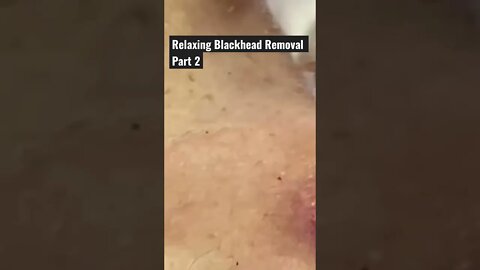 Satisfying Blackhead Removal Soothing Music #shorts #blackheads #pimpleremoval #pimplepopping