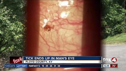 Tick latches on to man's eye