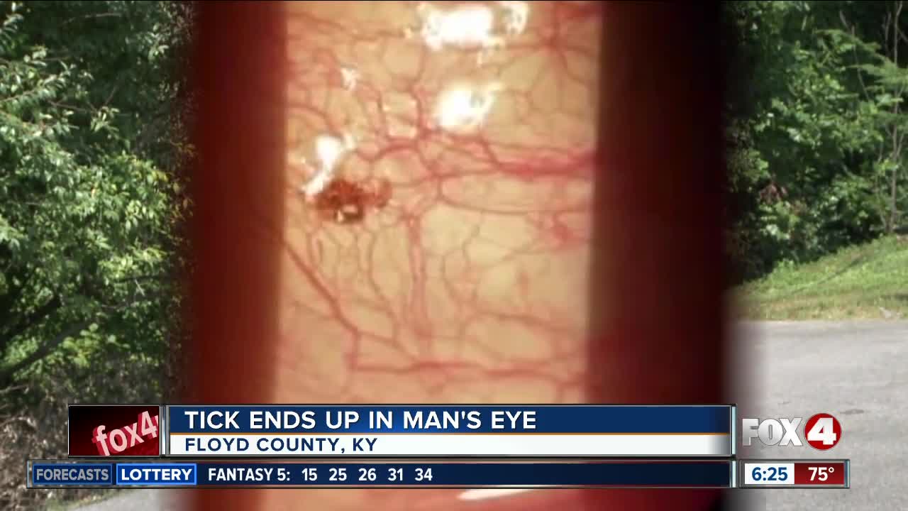 Tick latches on to man's eye