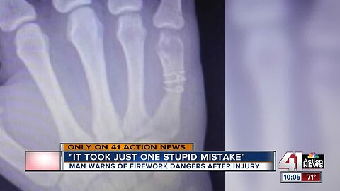 Surgeon, victim warn of firework hand injuries: 'Looked like hamburger meat'