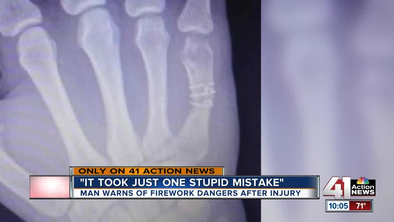 Surgeon, victim warn of firework hand injuries: 'Looked like hamburger meat'