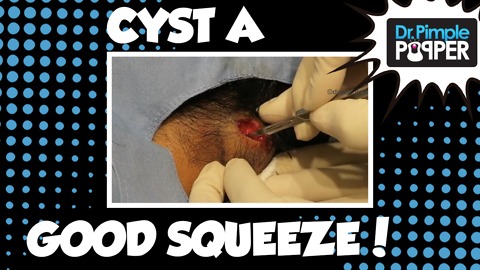 Dr Pimple Popper: Big Scalp Cyst