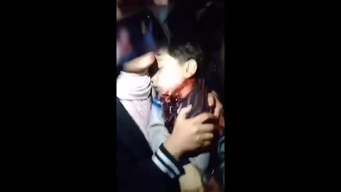 US and Israel dropped bomb on refugee camp. This video shows a boy named Fadi who was wounded.