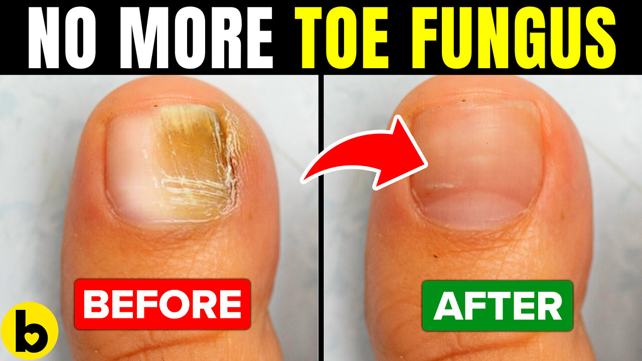 12 Ways To Get Rid of Toenail Fungus Fast and Naturally