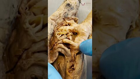 Can You Tell What’s Wrong With This Lung?