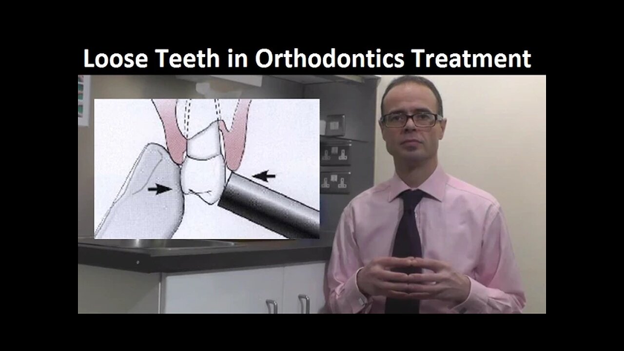 Do Orthodontic Braces, Brackets & Appliances Make Teeth Loose & Possibly Fall Out by Dr Mike Mew