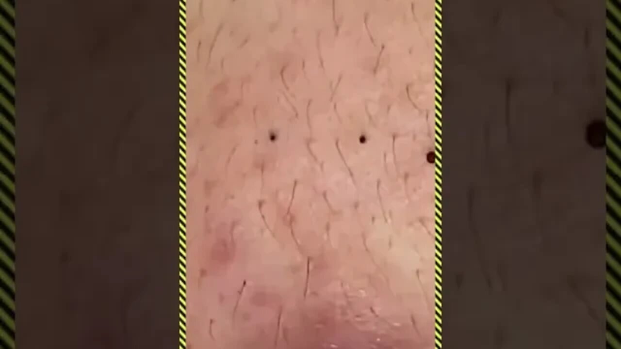 full blackheads Espremendo Espinhas e Cravos #shorts #0012