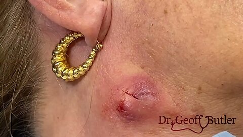 Drainage of an inflamed/infected cyst on the neck