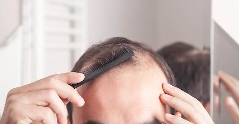 CAN HAIR LOSS BE REVERSED IN MEN?