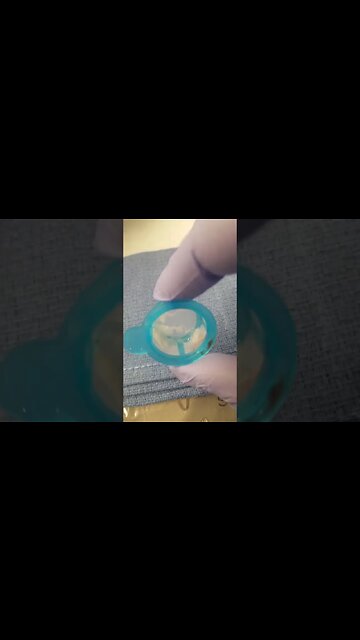 Strange Substance Sucked Out of Patient's Artery