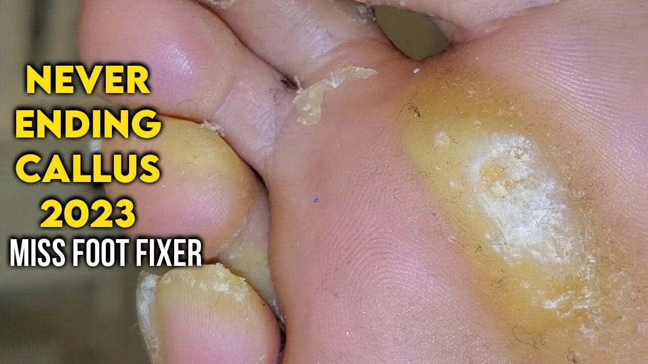 CALLUS EVERYWHERE ON FOOT 2023 [ NEVER ENDING CALLUS SCRAPING ] BY FOOT SPECIALIST MISS FOOT FIXER