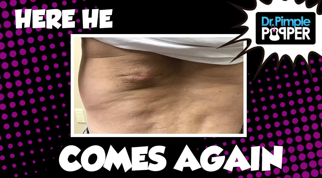 Here he Comes Again... The Petrified Cyst Returns