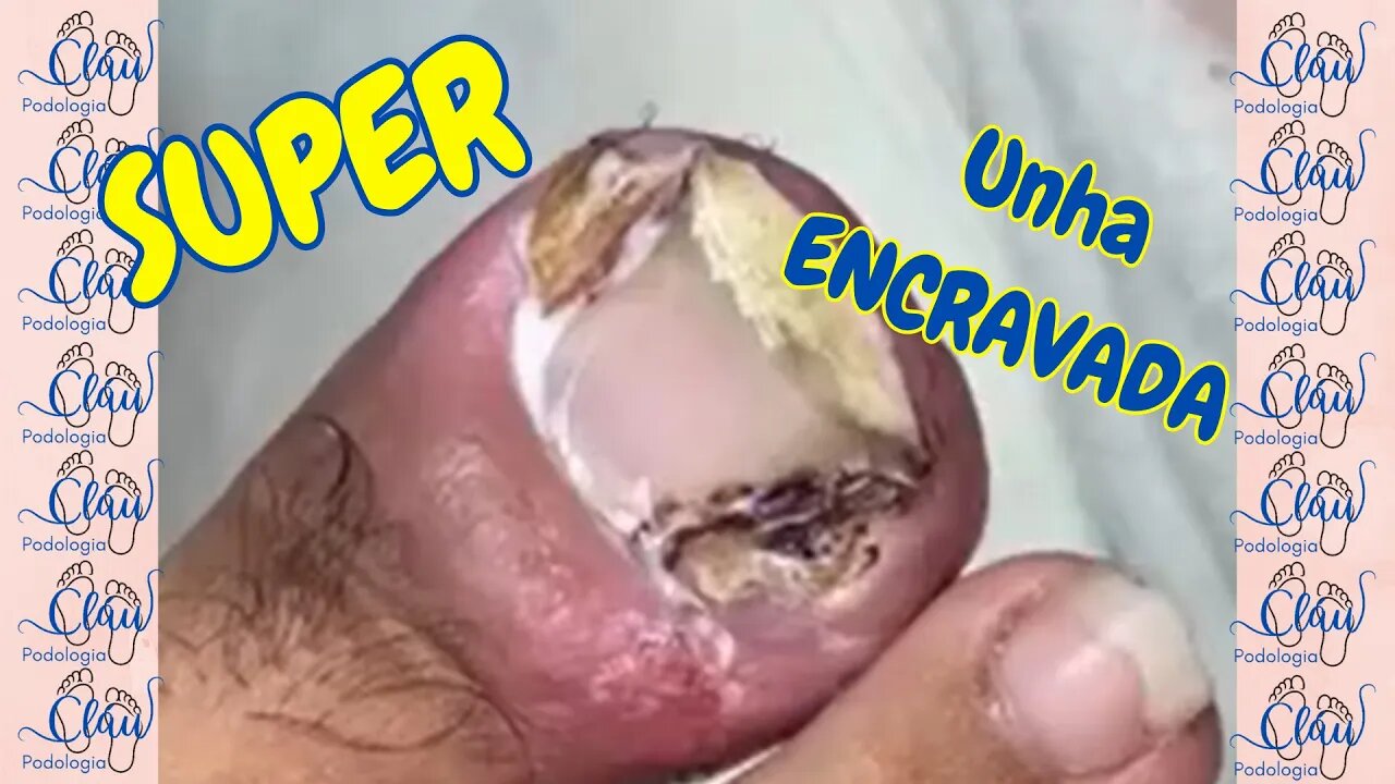 UNHA encravada com GRANULOMA e INFECCIONADA #unhas #pes #dor #podologia