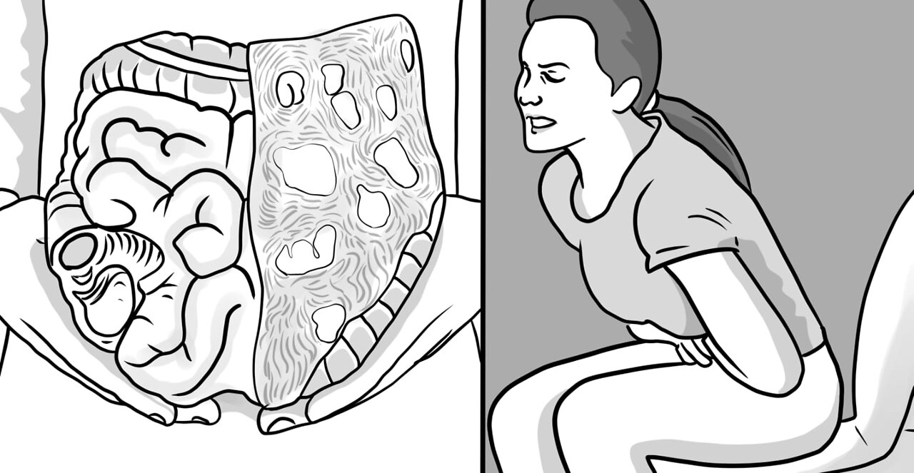 Get Rid Of Constipation & Poop Better