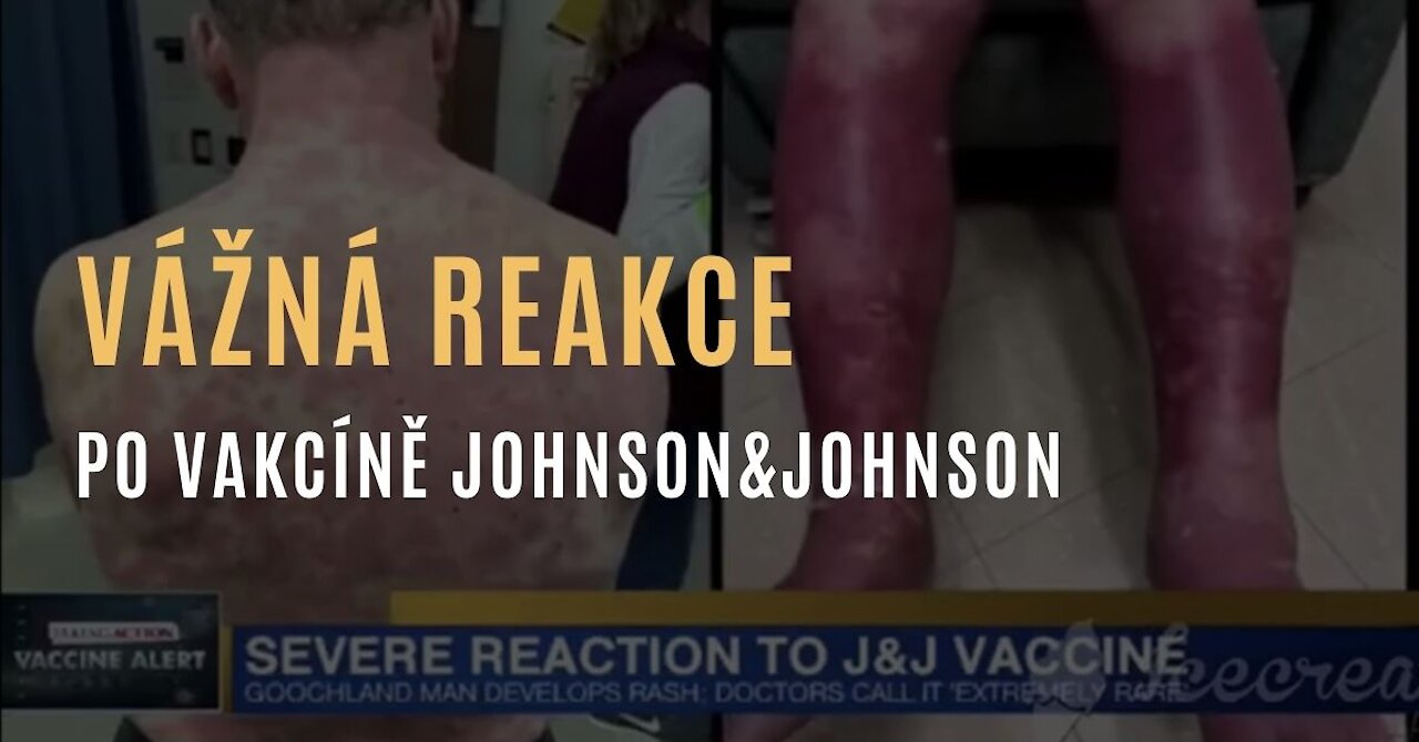 Vážná vyrážka a zrudnutí kůže po vakcíně Johnson&Johnson