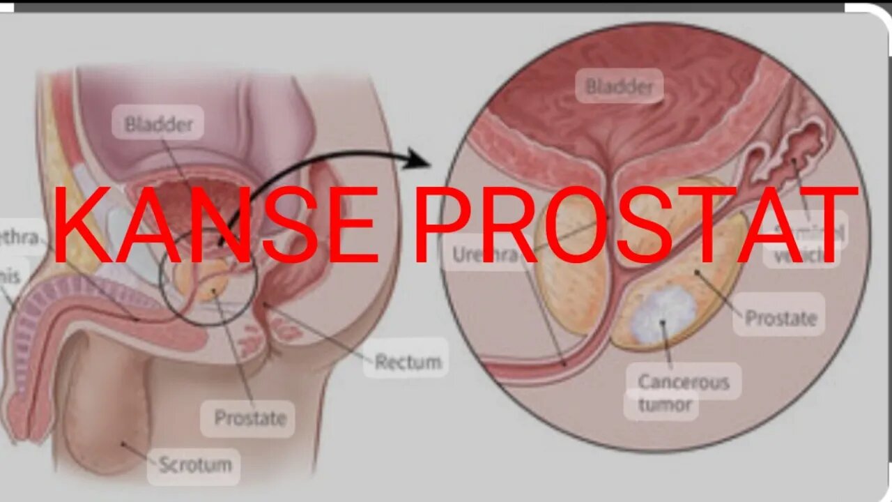 ti koze sou la sante ak dokte Gabart Moise "kanse prostat