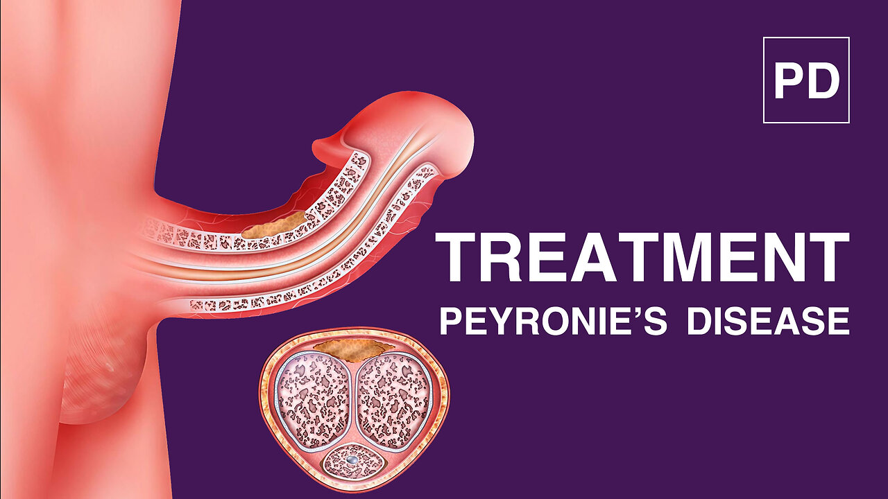 Shockwave therapy for Peyronies Disease, Disorder, bent, and curvature. Treatments and cure.