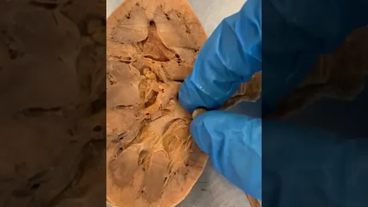 Real Kidney Stone In a Real Kidney