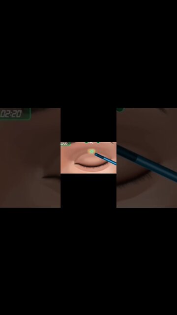 Asmr| cataract surgery| eyes muscle| glaucoma| corneal transplant|