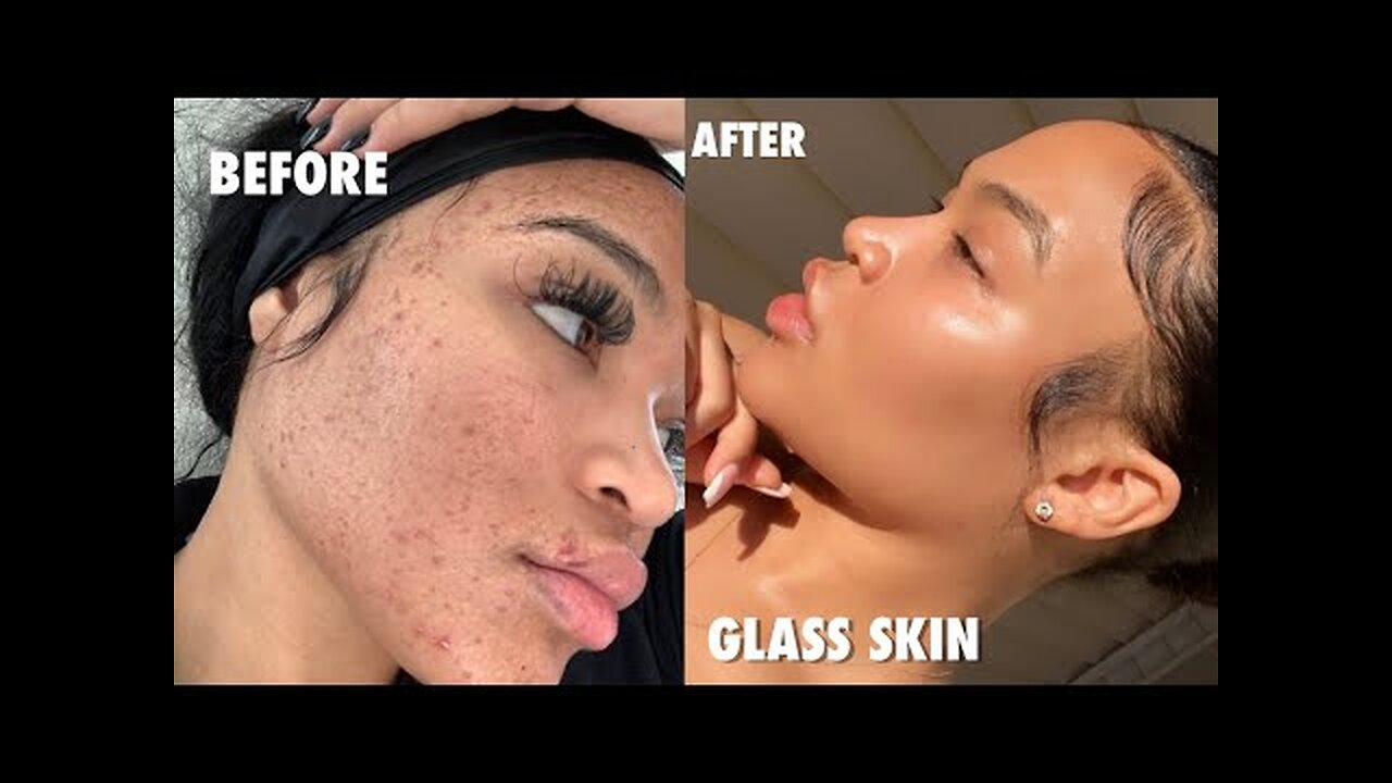 HOW I CLEARED MY ACNE FOR GOOD IN ONE WEEK (NO ACCUTANE) + SKINCARE GIVEAWAY | SKINCARE ROUTINE 2020