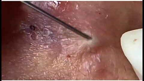 Massive Whiteheads Extraction