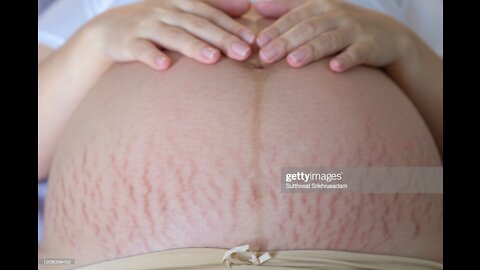 HOW TO REMOVE STRETCHES AT HOME (IN 3 DAYS)
