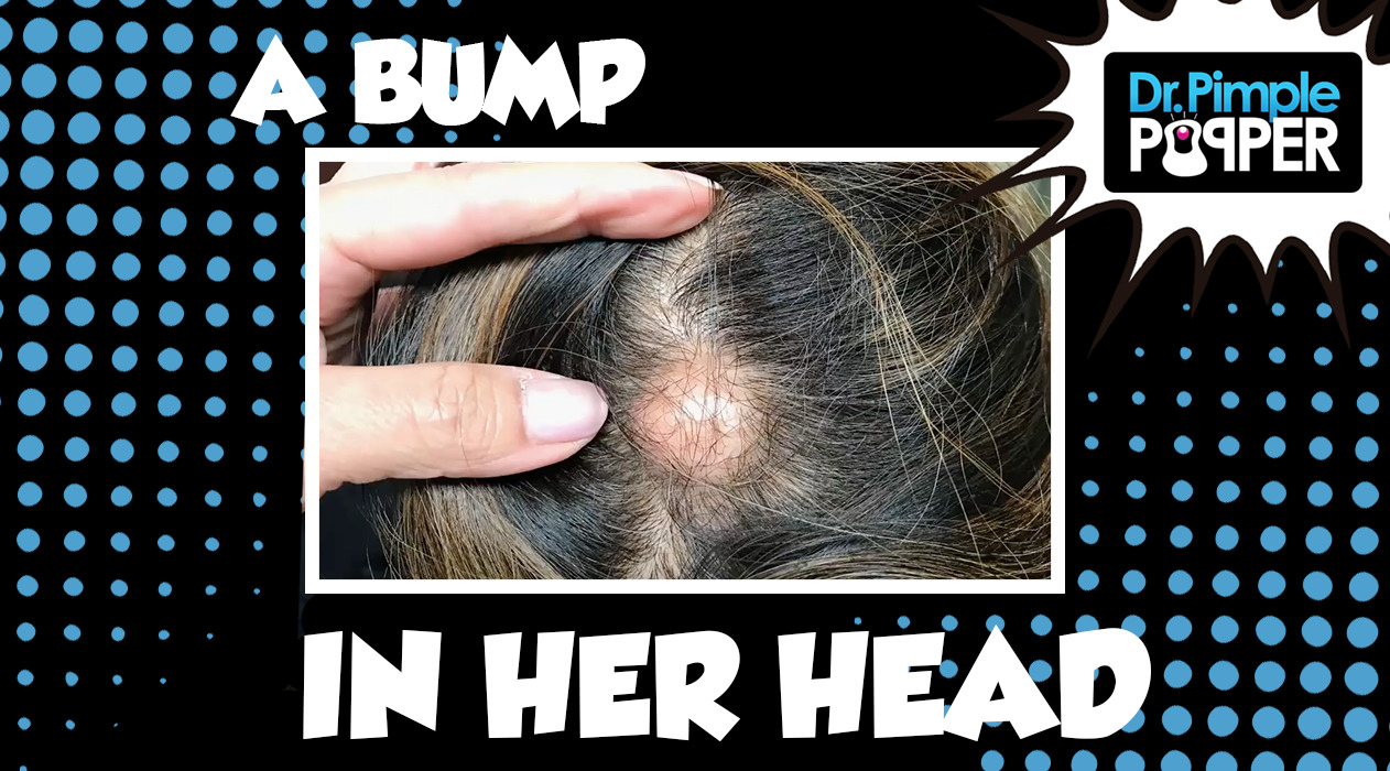 The Bump in Her Head...