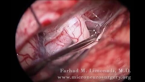 Brain Aneurysm clipping: Surgical clipping of an acom aneurysm (brain surgery) skull base