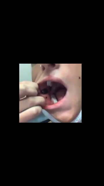 Busted blood vessels all over body caused by the COVID injection