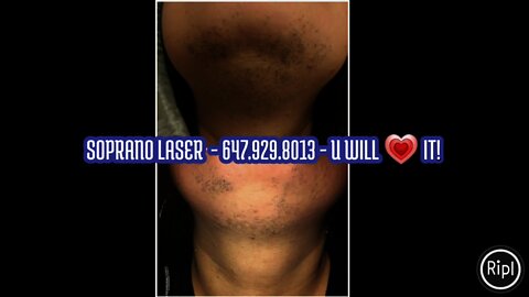 Soprano Laser - 647.929.8013 - U will 💗 it!