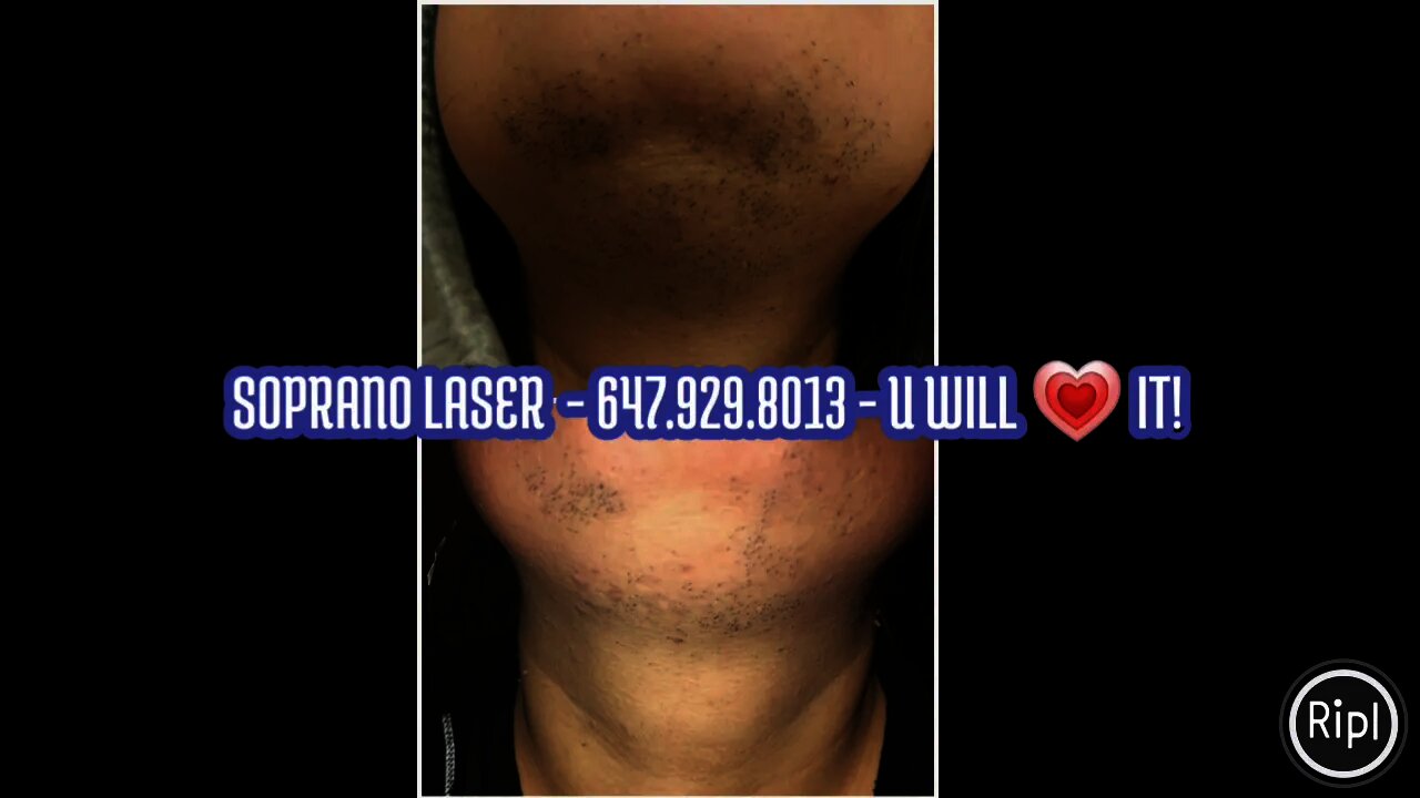 Soprano Laser - 647.929.8013 - U will 💗 it!