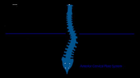 STERILE SPINE: Posterior Cervical Laminectomy and Fusion Intro Video