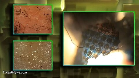 Morgellons Presentation (Potent News Blast #10)