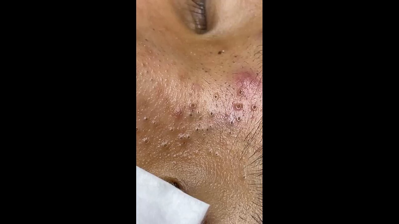 deep cleaning pimple