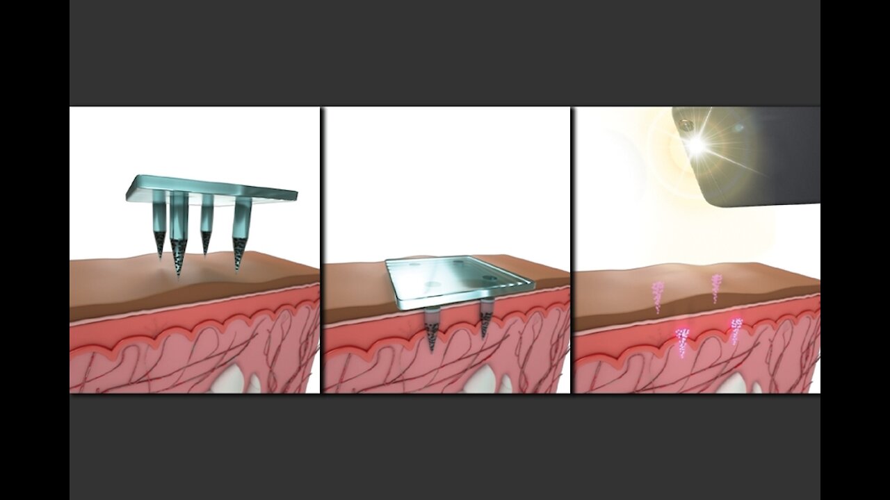 NIH creates Microneedle Flu Vaccine, U.S/Denmark Spied On EU Allies, China Bird Flu? PA wants Audit