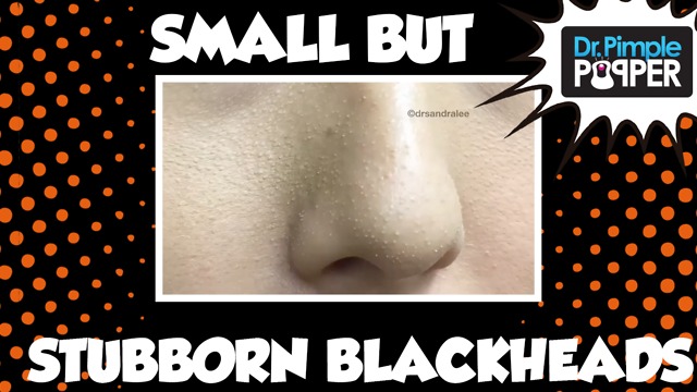 Tough blackhead extractions on the nose, Part 1