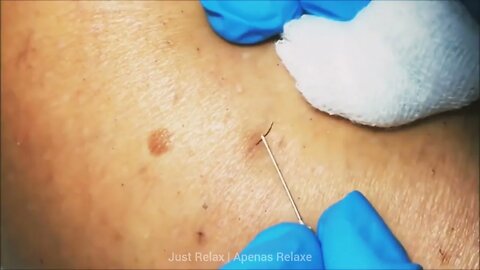 Só Relaxe Remoção de Pelos Encravados Vídeos Satisfatórios - Just Relax | Apenas Relaxe