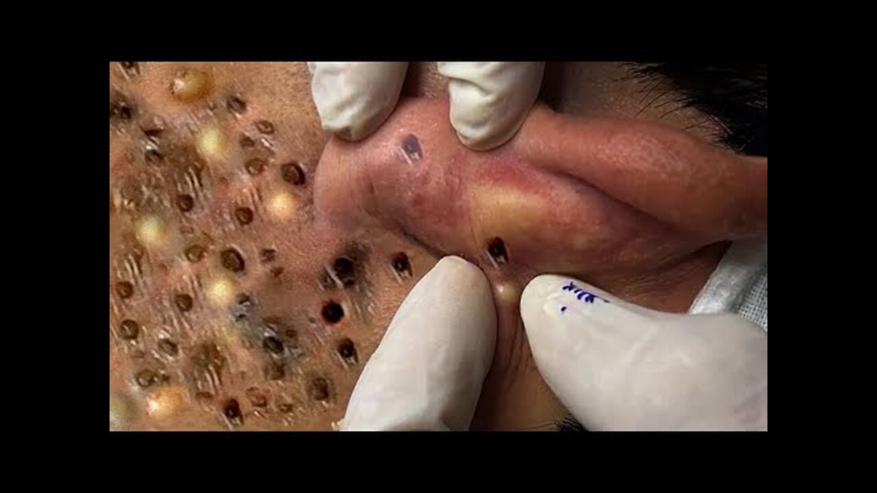 Perfect Skincare Blackhead Removal