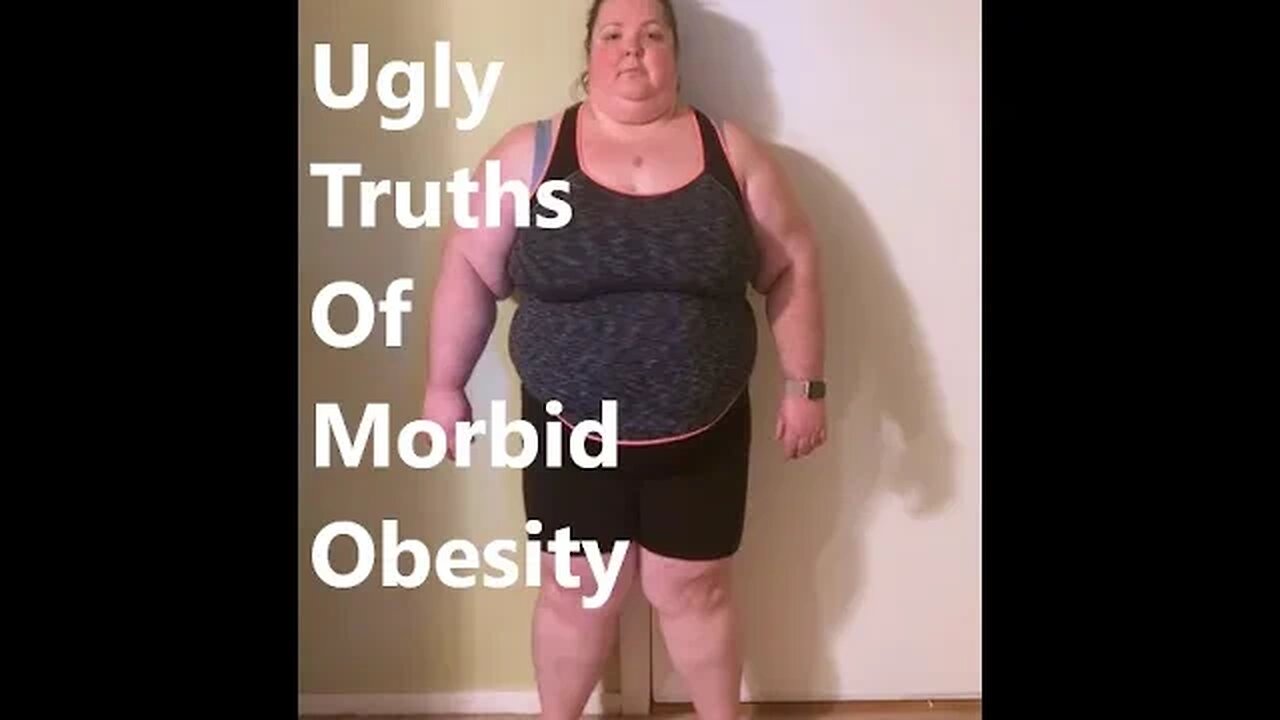 Ugly Truths of Morbid Obesity