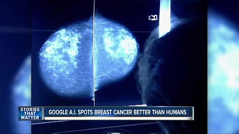 Google says AI can spot breast cancer better than humans