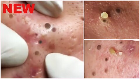 Removal Pimple