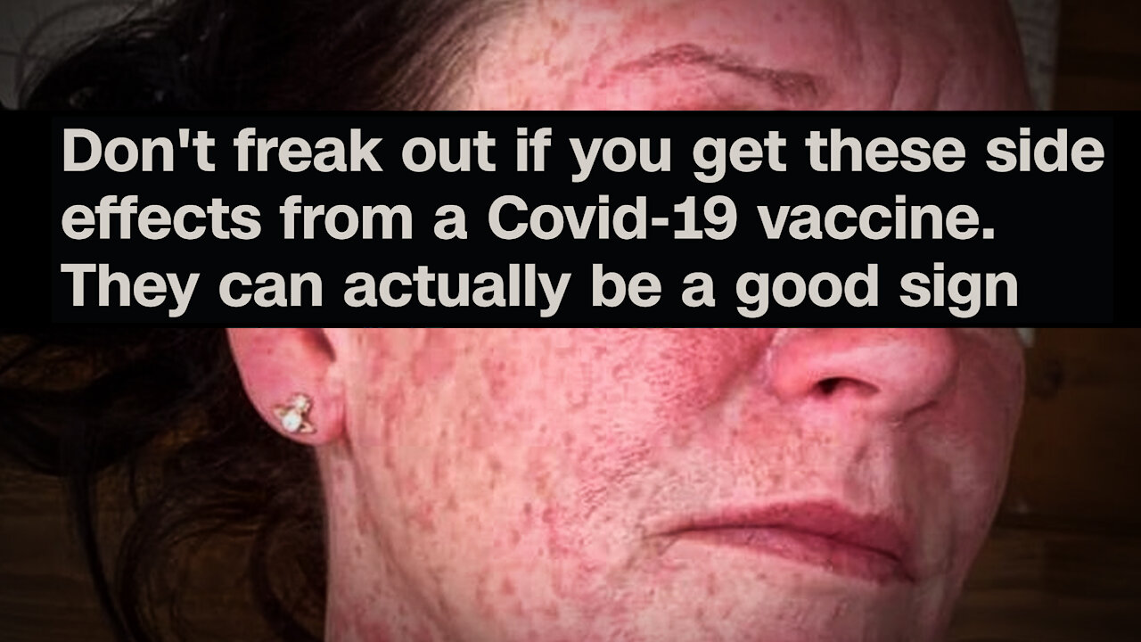 CNN Promotes Vaccine Side Effects As A Positive Thing