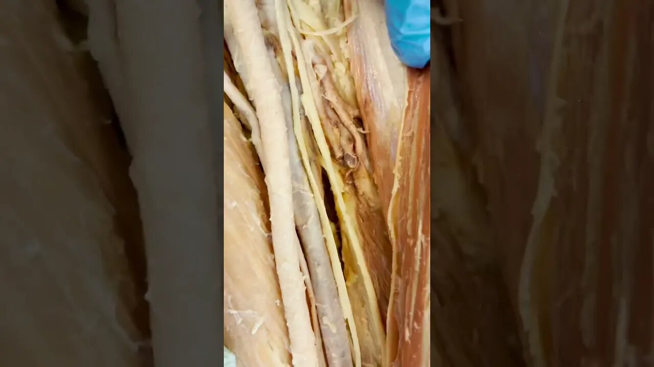 LOOK At This Huge Artery & Nerve - Femoral Triangle!