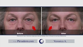 Get ready to be amazed with Plexaderm!