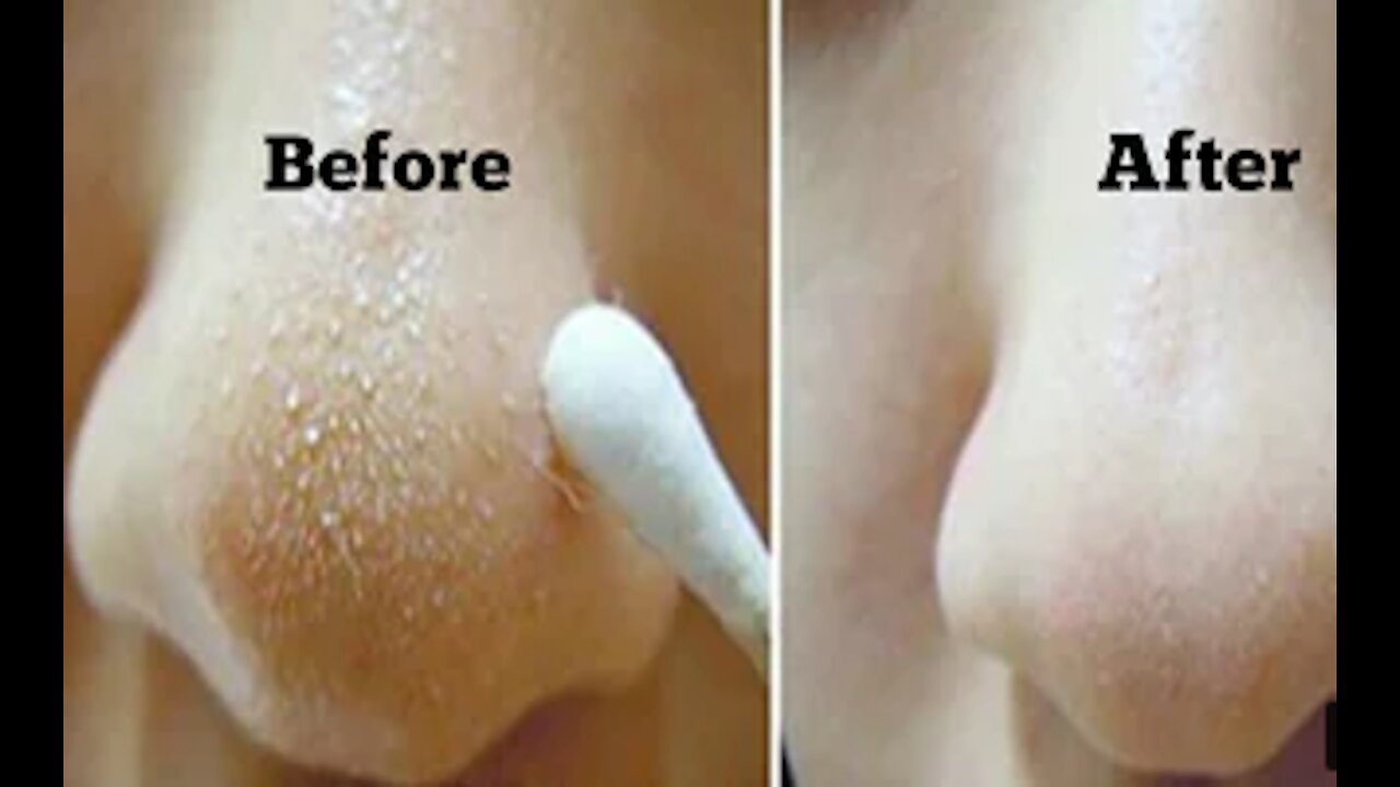 How to Get Rid of Blackheads & Whiteheads At Home