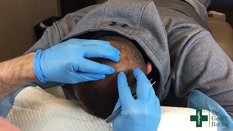 Removal of a small pilar cyst on the scalp