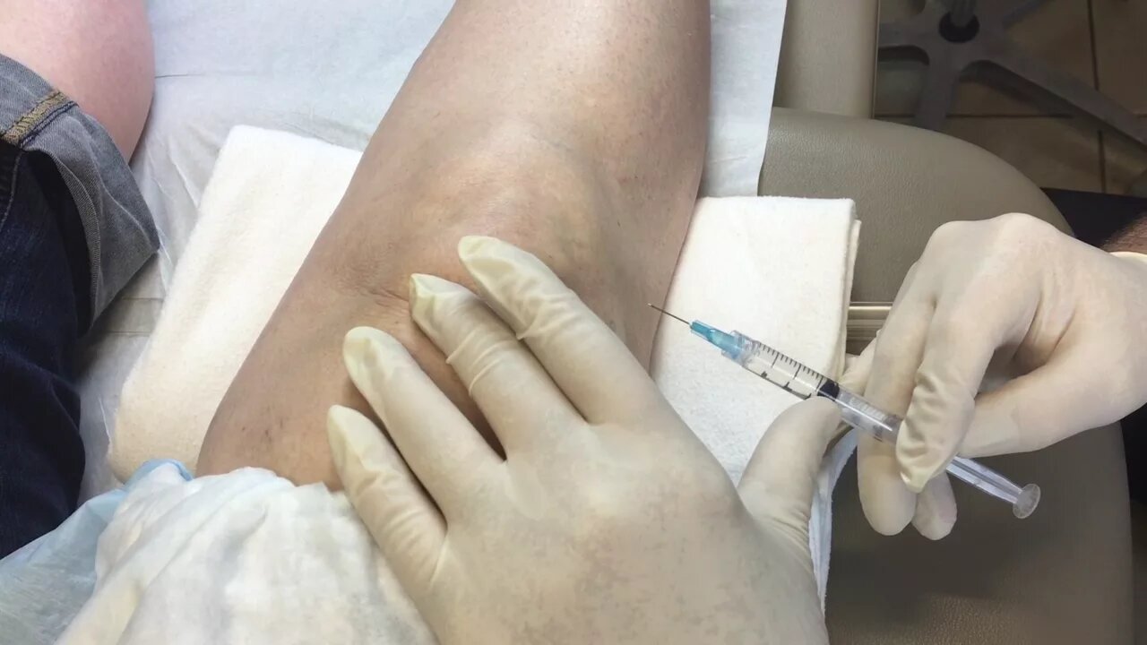 Lateral Retropatellar Injection of Euflexxa